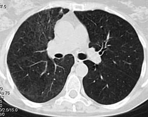 КТ органов грудной клетки