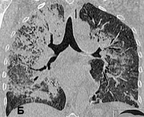 КТ органов грудной клетки