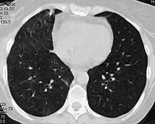 КТ органов грудной клетки