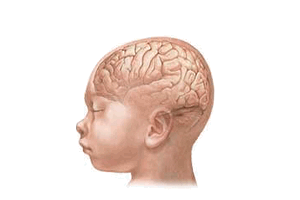 Микроцефалия