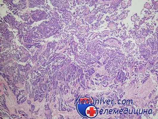 липосаркома