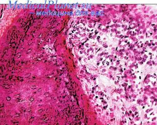 остеосаркома