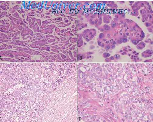миксоидная хондросаркома