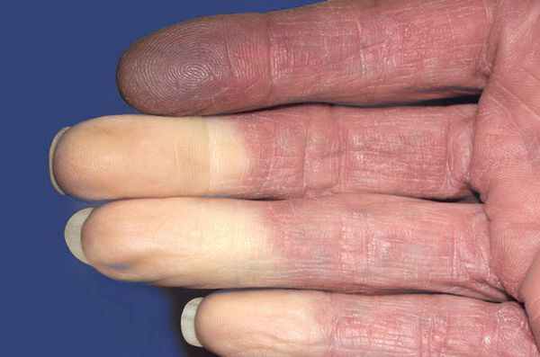 Синдром Рейно