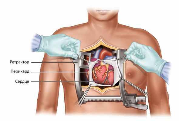 Стернотомия