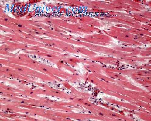 гипетрофия миокарда