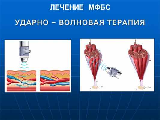  ЛЕЧЕНИЕ МФБС УДАРНО – ВОЛНОВАЯ ТЕРАПИЯ