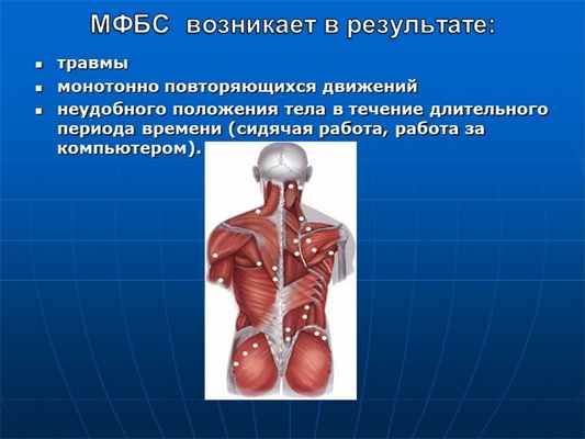 МФБС возникает в результате: травмы монотонно повторяющихся движений неудо. 