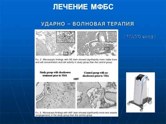  ЛЕЧЕНИЕ МФБС УДАРНО – ВОЛНОВАЯ ТЕРАПИЯ / WANG 2005 / 