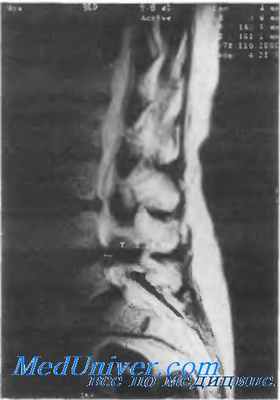 Мышечно-фасциальный синдром остеохондроза. Компрессионные синдромы остеохондроза позвоночника