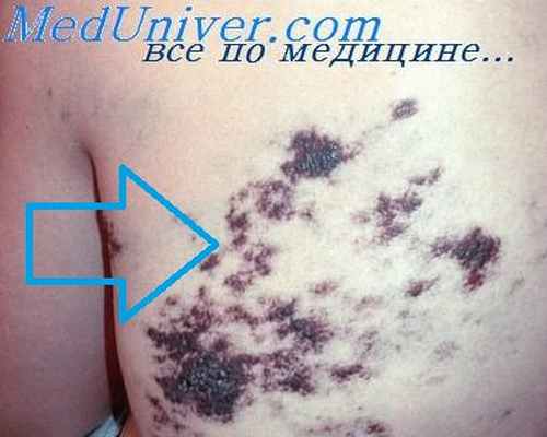 гемангиома