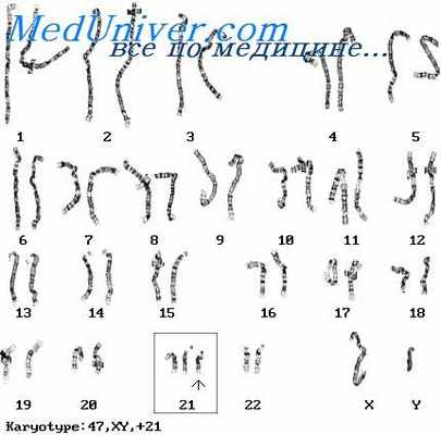 анеуплоидия