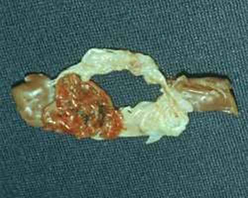 Митральный клапан