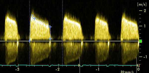 стеноз митрального клапана
