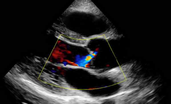 недостаточность аортального клапана