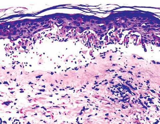 Изменение кожи при МЭЭ
