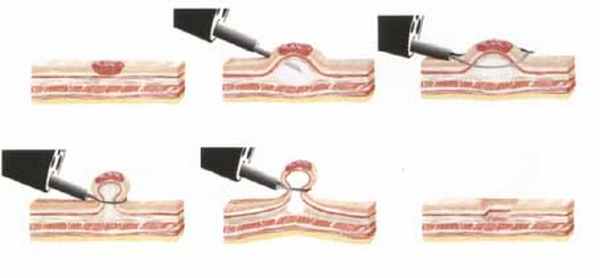 Эндоскопическая полипэктомия
