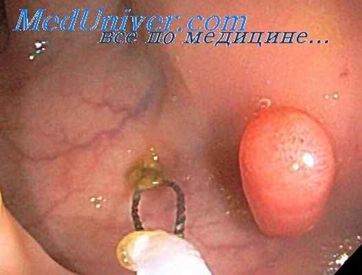 эндоскопическая полипэктомия