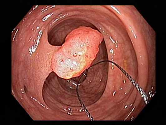 Эндоскопическая полипэктомия