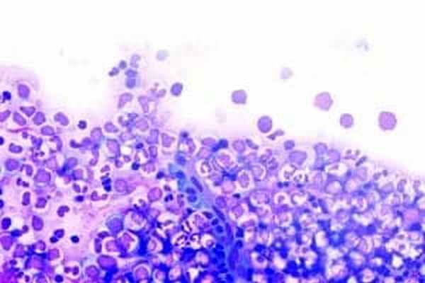 Множественная миелома (миеломная болезнь): лечение, диагностика, симптомы