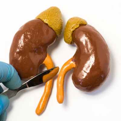 Рак мочеточников