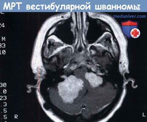 МРТ вестибулярной шванномы