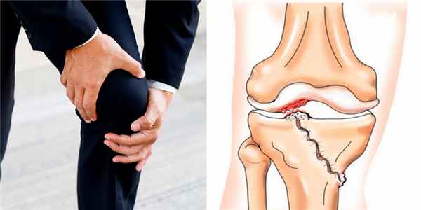 Симптомы посттравматического артрита