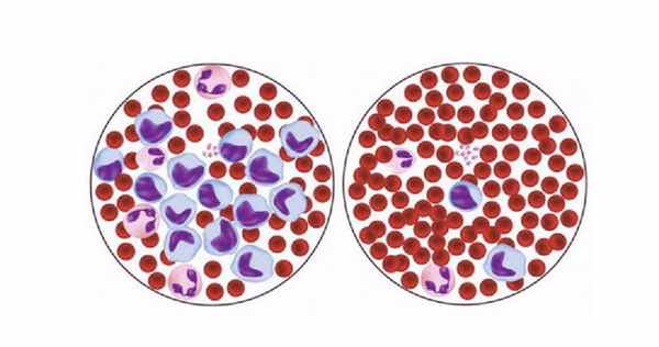 Моноциты в крови