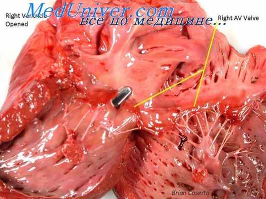 дефект межпредсердной перегородки
