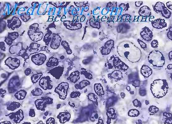 фолликулярные лимфомы