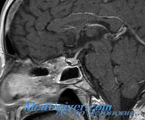 морфология гигантизма