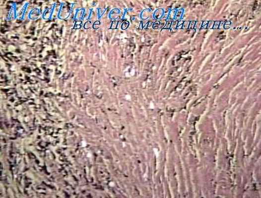 карциноматозный лимфангиоз