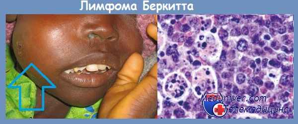Лимфома Беркитта