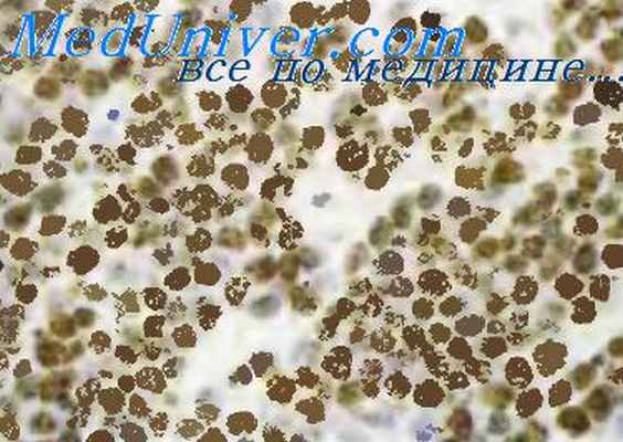 лимфома беркитта