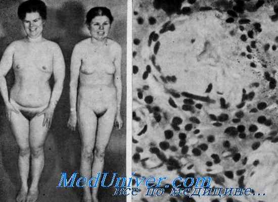 синдром альстрема