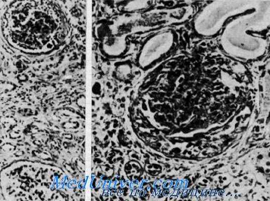 наследственность синдрома альпорта