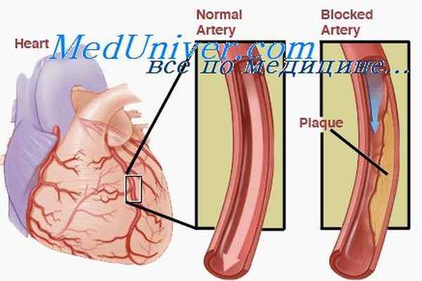 Нестабильная стенокардия