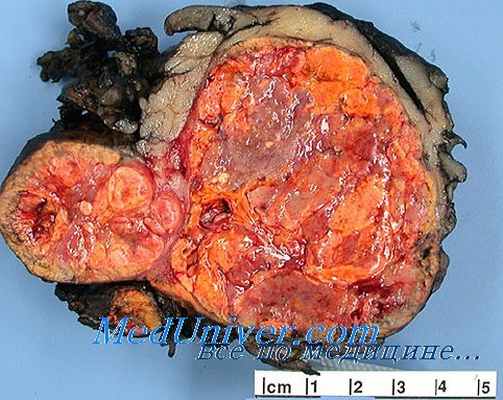 опухоли надпочечников