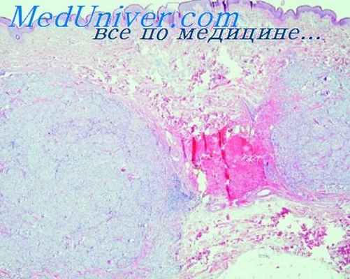 морфология оспы