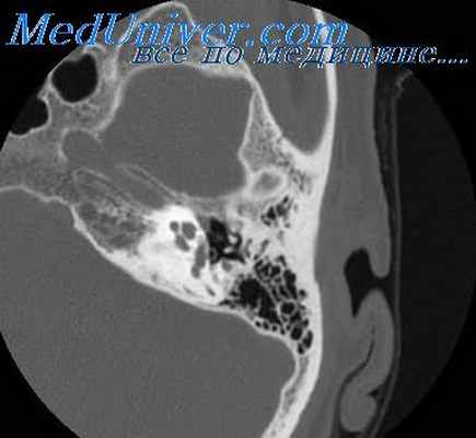 отоспонгиоз