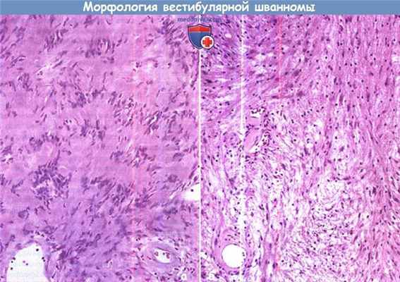 Морфология и патологическая анатомия вестибулярной шванномы