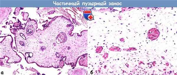 Частичный пузырный занос