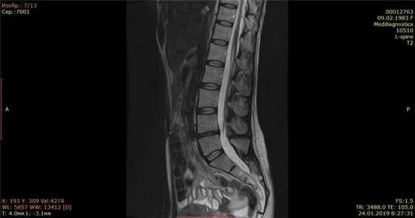 Контрольный МРТ, через 5 месяцев показал полное отсутствие грыжи диска