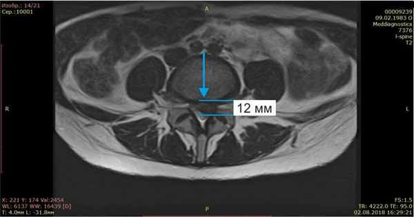 МРТ позвоночника до лечения грыжи диска