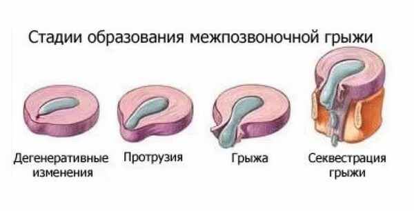 Мануальная терапия при грыже поясничного отдела позвоночника