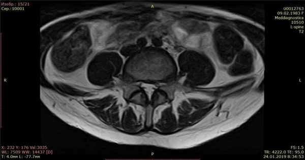 МРТ позвоночника после лечения грыжи диска