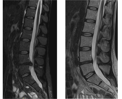 МРТ позвоночника до- и после лечения грыжи диска
