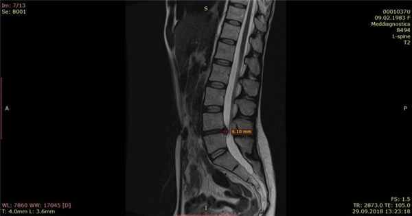 МРТ позвоночника, через 1 месяц грыжа уменьшилась на 50%