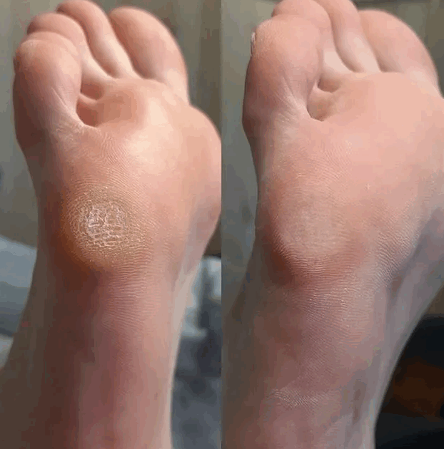 натоптыши причины