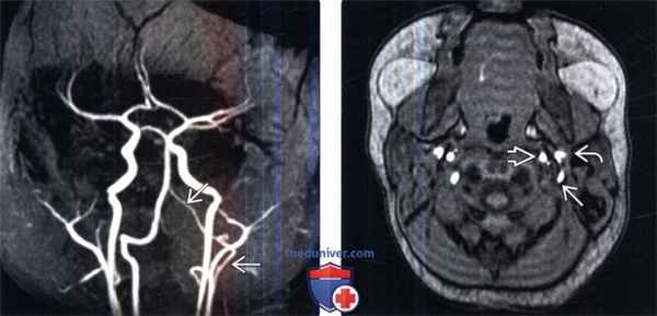 МРТ, ангиограмма при персистирующей артерии проатланта